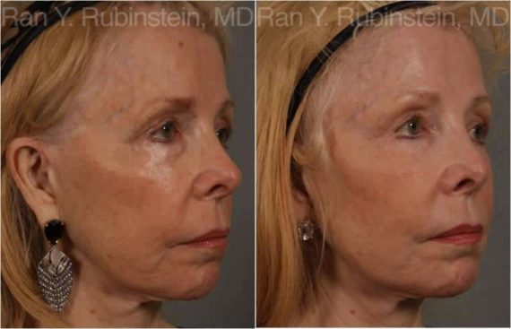 Dermal Fillers Before and After Photos in Montvale, NJ, Patient 12739