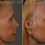 Dermal Fillers Before and After Photos in Montvale, NJ, Patient 12739