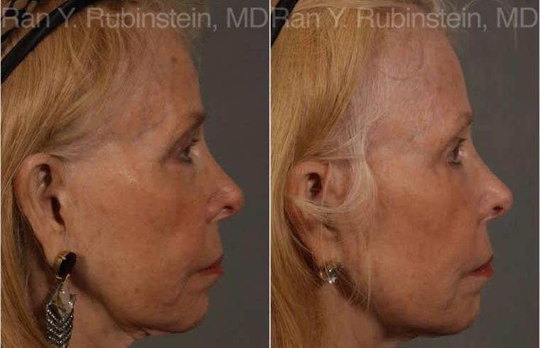 Dermal Fillers Before and After Photos in Montvale, NJ, Patient 12739