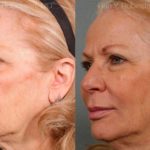 Sculptra Face Before and After Photos in Montvale, NJ, Patient 12744
