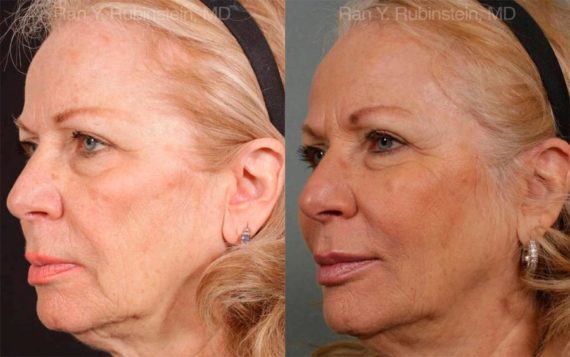 Sculptra Face Before and After Photos in Montvale, NJ, Patient 12744