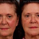 Dermal Fillers Before and After Photos in Montvale, NJ, Patient 12750