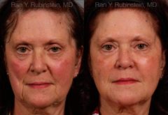 Dermal Fillers Before and After Photos in Montvale, NJ, Patient 12750