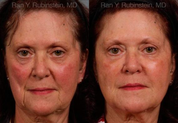 Dermal Fillers Before and After Photos in Montvale, NJ, Patient 12750
