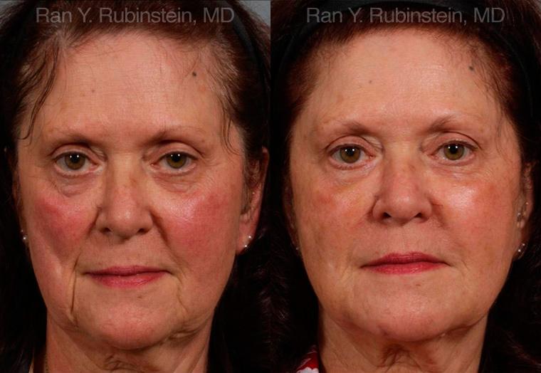 Dermal Fillers Before and After Photos in Montvale, NJ, Patient 12750
