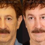 Dermal Fillers Before and After Photos in Montvale, NJ, Patient 12753