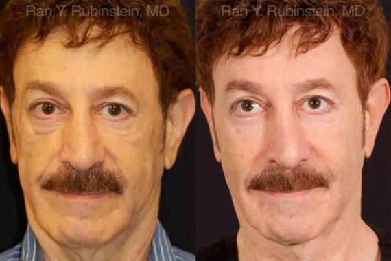Dermal Fillers Before and After Photos in Montvale, NJ, Patient 12753