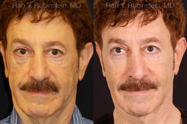 Dermal Fillers Before and After Photos in Montvale, NJ, Patient 12753