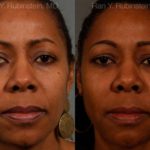 Dermal Fillers Before and After Photos in Montvale, NJ, Patient 12756