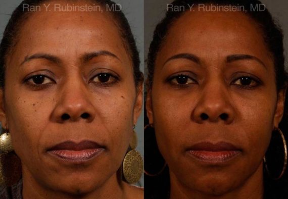 Dermal Fillers Before and After Photos in Montvale, NJ, Patient 12756