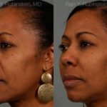 Dermal Fillers Before and After Photos in Montvale, NJ, Patient 12756