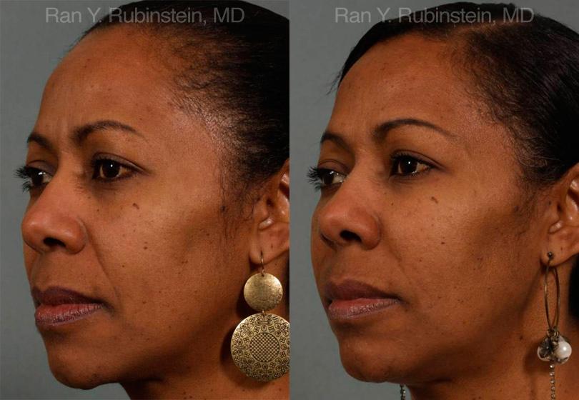 Dermal Fillers Before and After Photos in Montvale, NJ, Patient 12756