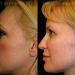 Sculptra Face Before and After Photos in Montvale, NJ, Patient 12782