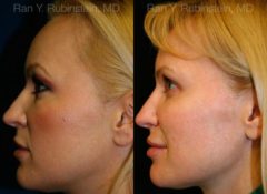 Sculptra Face Before and After Photos in Montvale, NJ, Patient 12782