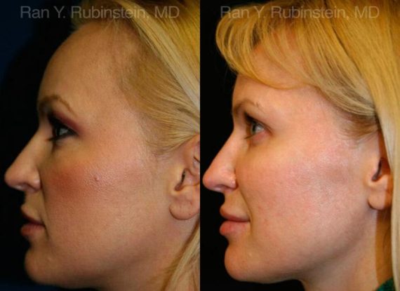 Sculptra Face Before and After Photos in Montvale, NJ, Patient 12782