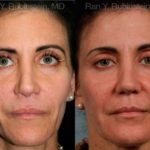 Sculptra Face Before and After Photos in Montvale, NJ, Patient 12788