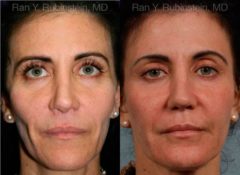 Sculptra Face Before and After Photos in Montvale, NJ, Patient 12788
