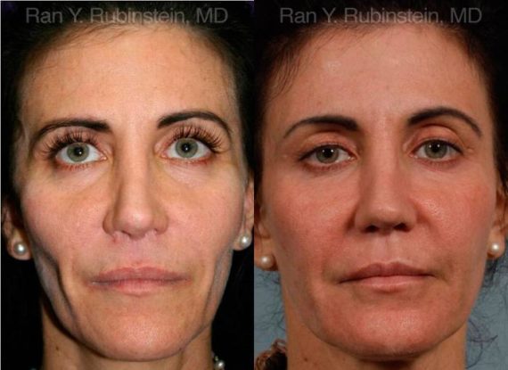 Sculptra Face Before and After Photos in Montvale, NJ, Patient 12788