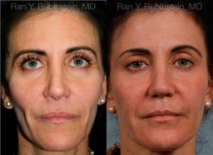Sculptra Face Before and After Photos in Montvale, NJ, Patient 12788