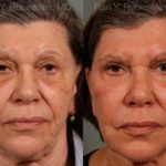 Sculptra Face Before and After Photos in Montvale, NJ, Patient 12791