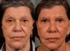 Sculptra Face Before and After Photos in Montvale, NJ, Patient 12791