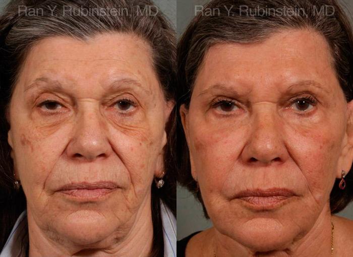 Sculptra Face Before and After Photos in Montvale, NJ, Patient 12791