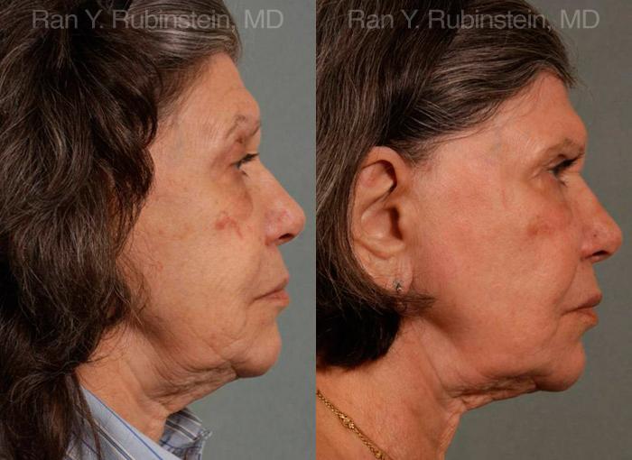 Sculptra Face Before and After Photos in Montvale, NJ, Patient 12791