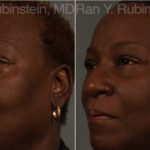 Dermal Fillers Before and After Photos in Montvale, NJ, Patient 12796