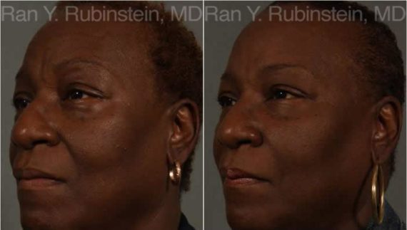 Dermal Fillers Before and After Photos in Montvale, NJ, Patient 12796