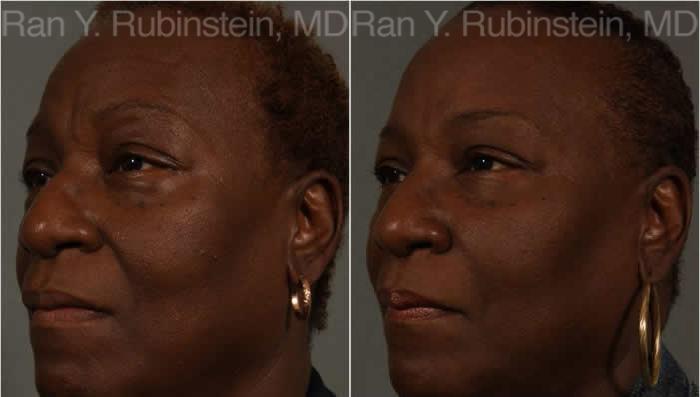 Dermal Fillers Before and After Photos in Montvale, NJ, Patient 12796