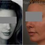 Dermal Fillers Before and After Photos in Montvale, NJ, Patient 12802