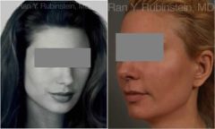 Dermal Fillers Before and After Photos in Montvale, NJ, Patient 12802