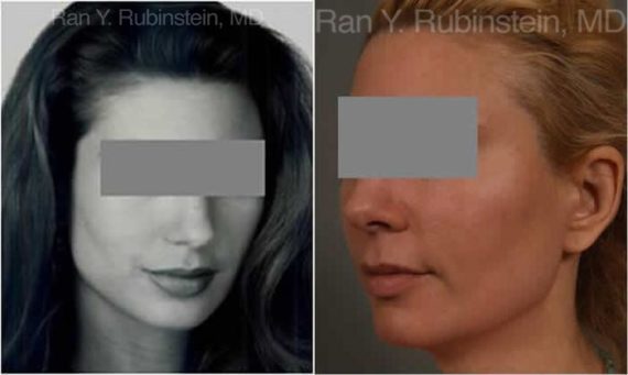 Dermal Fillers Before and After Photos in Montvale, NJ, Patient 12802