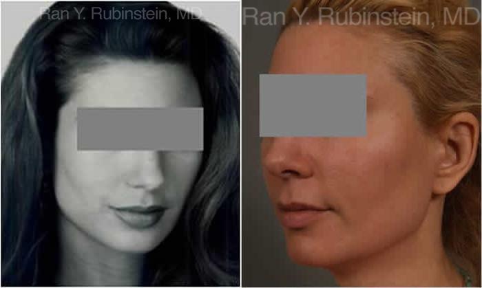 Dermal Fillers Before and After Photos in Montvale, NJ, Patient 12802