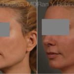 Dermal Fillers Before and After Photos in Montvale, NJ, Patient 12802