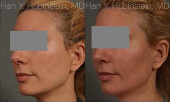 Dermal Fillers Before and After Photos in Montvale, NJ, Patient 12802
