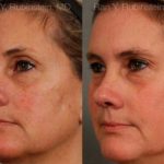 Laser Treatments Before and After Photos in Montvale, NJ, Patient 12817