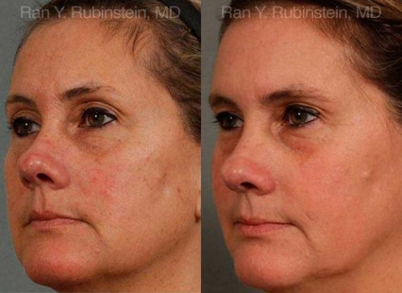 Laser Treatments Before and After Photos in Montvale, NJ, Patient 12817
