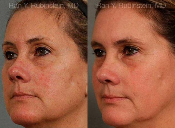 Laser Treatments Before and After Photos in Montvale, NJ, Patient 12817