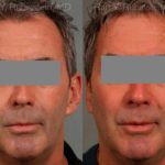 Otoplasty Before and After Photos in Montvale, NJ, Patient 12942