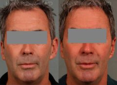 Otoplasty Before and After Photos in Montvale, NJ, Patient 12942