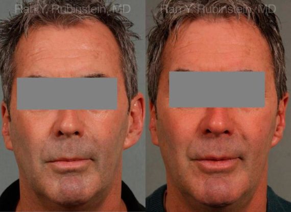 Otoplasty Before and After Photos in Montvale, NJ, Patient 12942