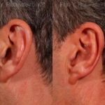 Otoplasty Before and After Photos in Montvale, NJ, Patient 12942