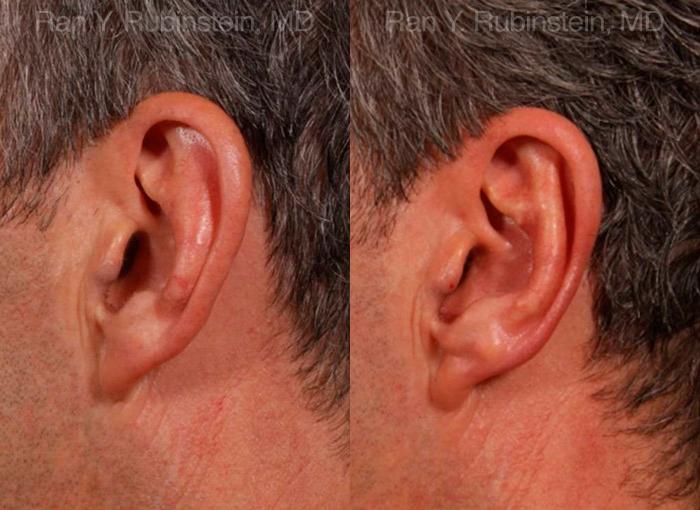 Otoplasty Before and After Photos in Montvale, NJ, Patient 12942