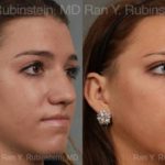 Rhinoplasty Before and After Photos in Montvale, NJ, Patient 13052