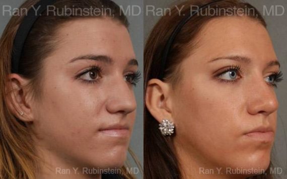 Rhinoplasty Before and After Photos in Montvale, NJ, Patient 13052