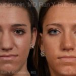 Rhinoplasty Before and After Photos in Montvale, NJ, Patient 13052