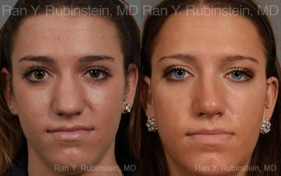 Rhinoplasty Before and After Photos in Montvale, NJ, Patient 13052