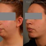 Laser Lift Precision Tx Before and After Photos in Montvale, NJ, Patient 13248