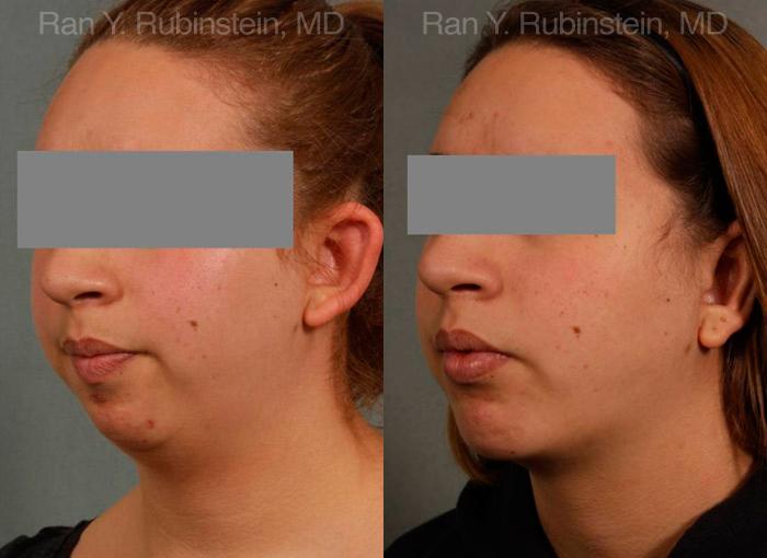 Laser Lift Precision Tx Before and After Photos in Montvale, NJ, Patient 13248
